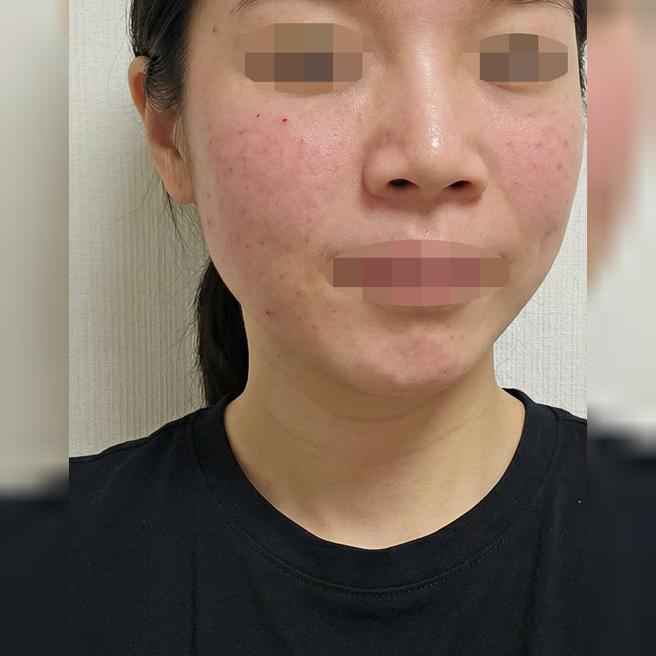 쥬베룩 받았는데 피부결 좋아져서 또 받으러 올 것 같아요 ~!