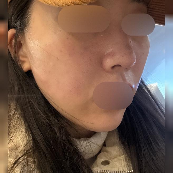 엠보 걱정했는데 마스크 없이 귀가 가능할 정도였어요!!
