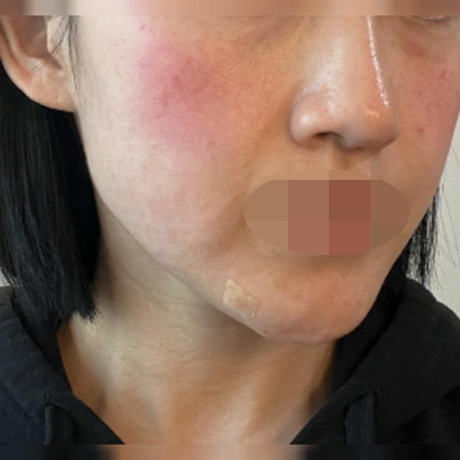수면으로 통증 없이 받은 리쥬란, 빠른 응대까지 좋았어요ㅎㅎ