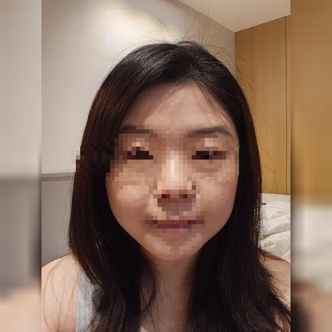 리쥬란 7일차, 피부결이 한층 매끄러워진 느낌