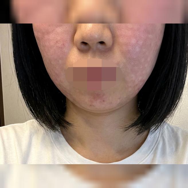 건조함 고민으로 시작한 리쥬란, 두 번째도 만족스럽게 다녀왔어요