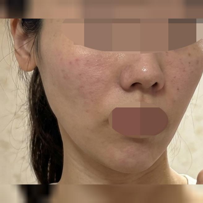 건조함이랑 눈가 잔주름 고민으로 받았는데 받길 잘한 것 같아요!