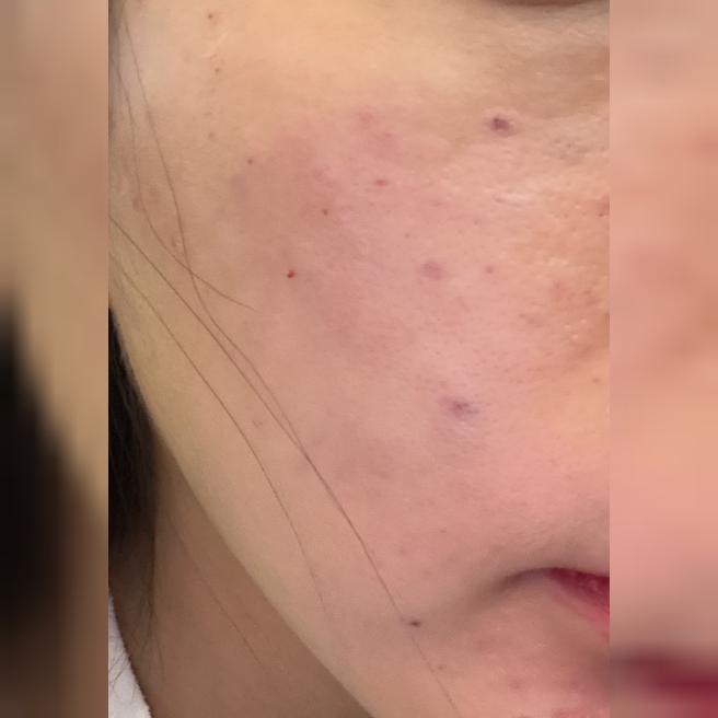 피지에 잔주름까지 신경 쓰여서 쥬베룩으로 한번 받아봤어요~