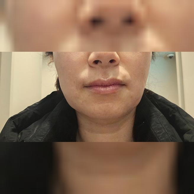 아플까봐 못 하다가 수면으로 받았는데 벌써 두 번째예요 ㅎㅎ
