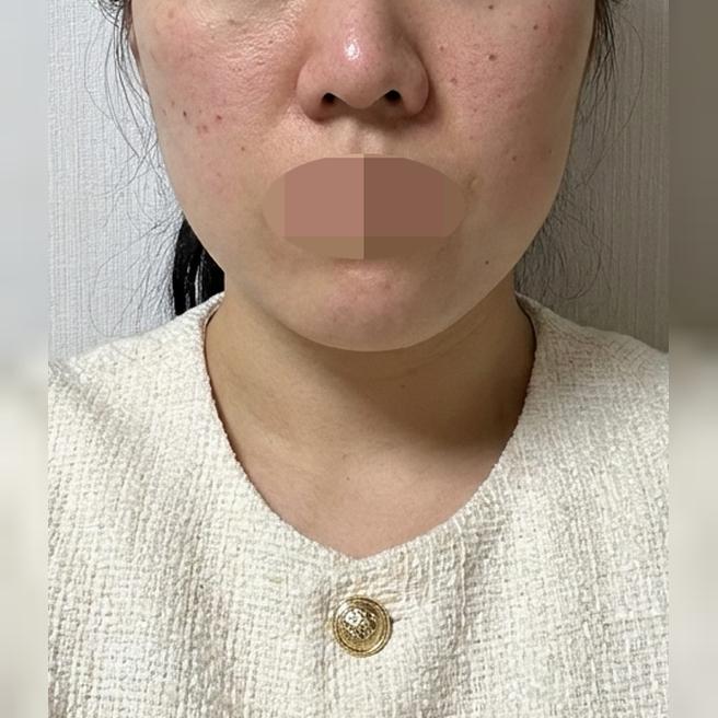 몇 번이나 방문하는 곳! 이번에도 리쥬란 받았어요~