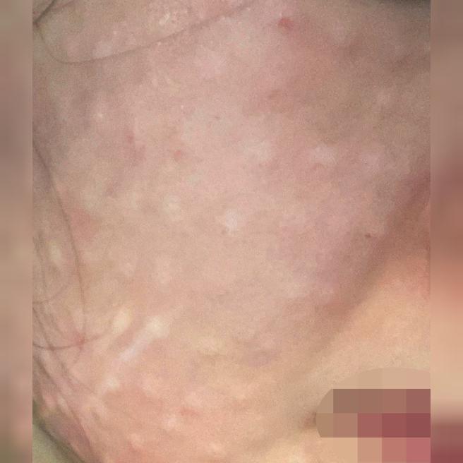 엠보 꼼꼼하게 잘 나와서 첫 리쥬란부터 만족이에요!!