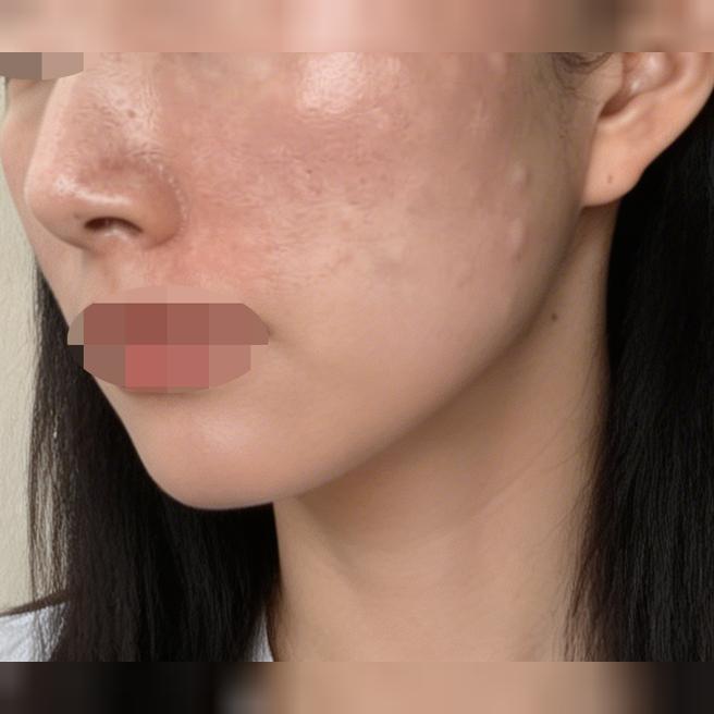 전체적으로 컨디션 떨어지고 트러블도 나기 시작해서 리쥬란 받아봤어요!