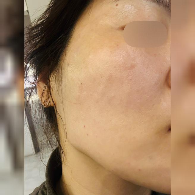 멍도 없고 후처리까지 완벽한 리쥬란, 앞으로 여기서 쭉 할게요~