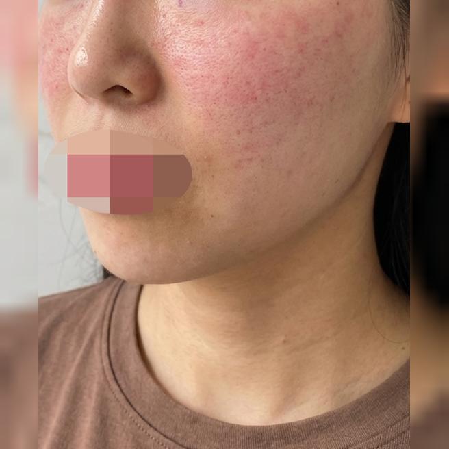 얼굴형 관리 시작할 때 됐다 싶어서 수면으로 한번에 받고 왔어요~