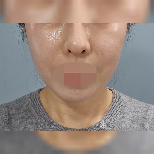흉터 하나 없이 일상생활 바로 가능! 만족해서 재방문 예정이에요~ㅎㅎ