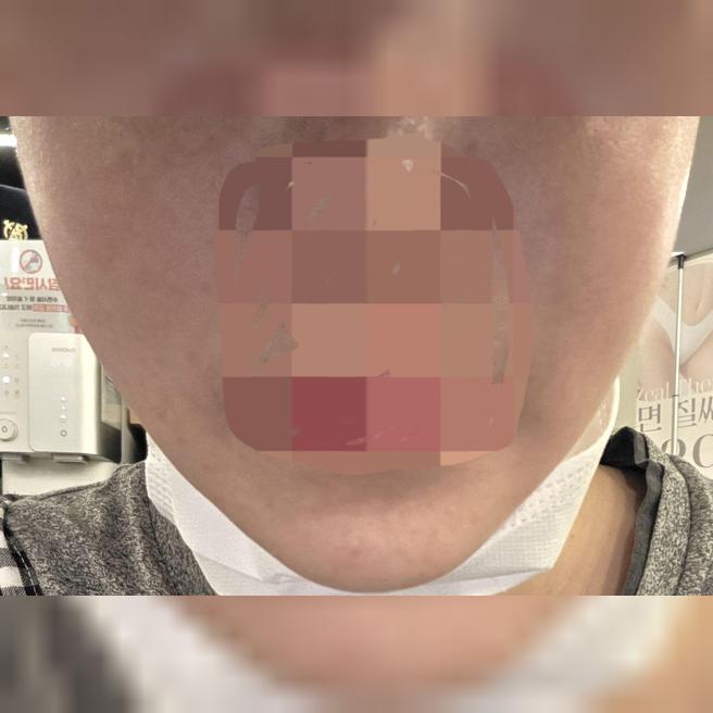 물광 주사 받았는데 통증이랑 붉은기 없어서 놀랐어요 ㅎㅎ
