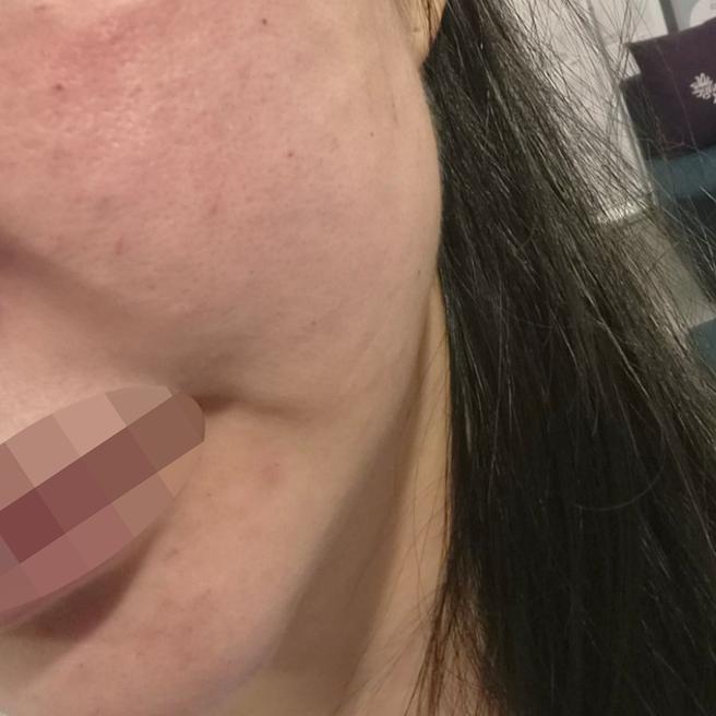 급하게 방문했는데 바로 시술 가능했어요~ 너무 만족이에요!