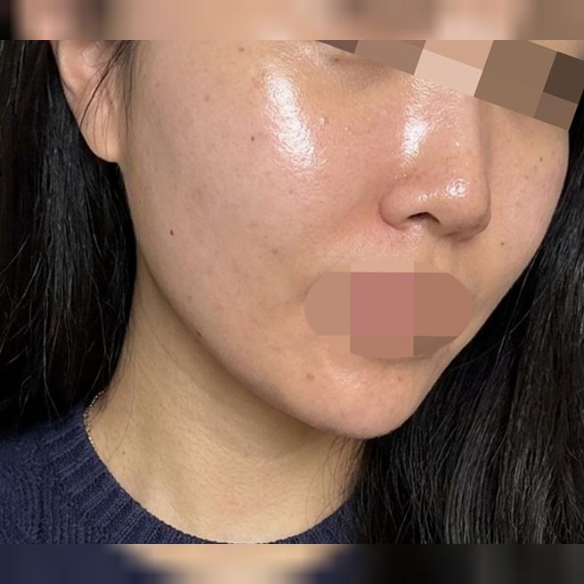 홈케어로는 한계인 피부 고민, 리쥬란으로 답을 찾았어요
