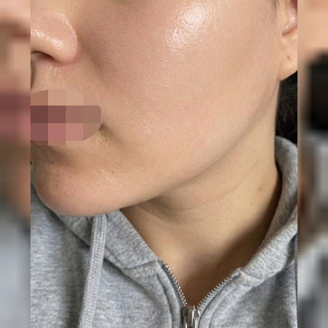 수면으로 통증 없이! 짧은 대기까지 만족스러운 엑소좀 후기예요!