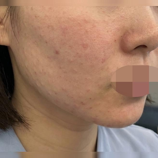 주변에서 피부 예쁘다고! 효과 확실해서 또 받으러 왔어요~~