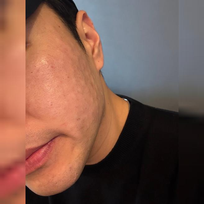 리쥬란힐러 두 번째도 만족! 효과 좋아서 또 왔어요 + 이번엔 보톡스까지!