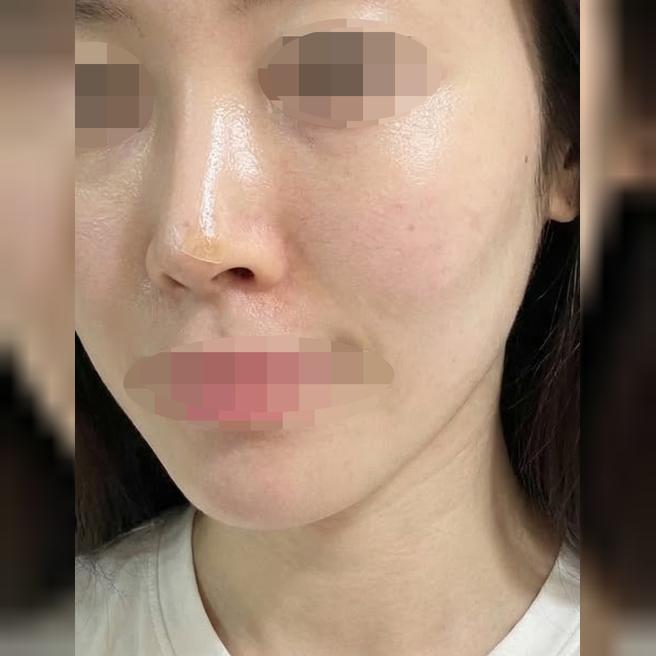 홍조 때문에 엑소좀 받았는데 하루 지나니까 좋아진 것 같아요 ㅎㅎ