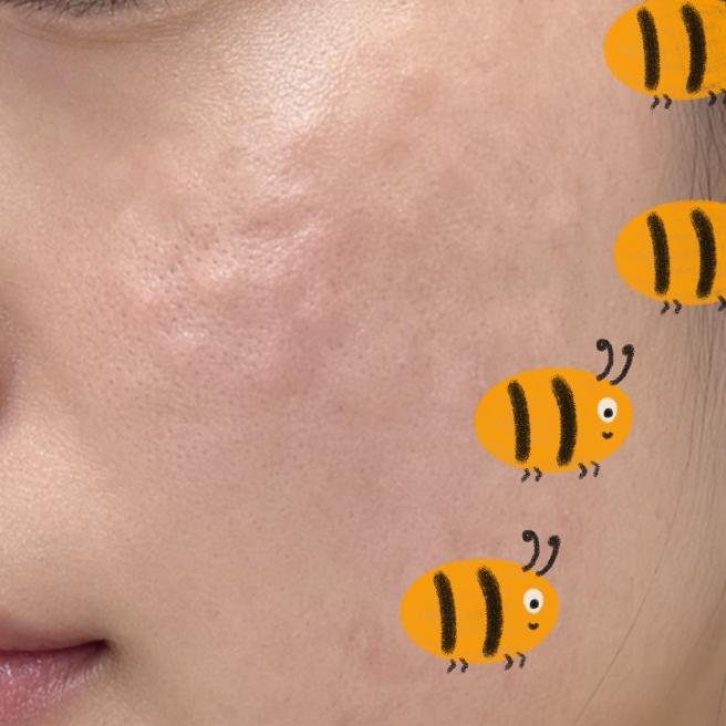 리쥬란 시술 받은 당일이에요~ 첫 시술부터 만족스러웠어요!