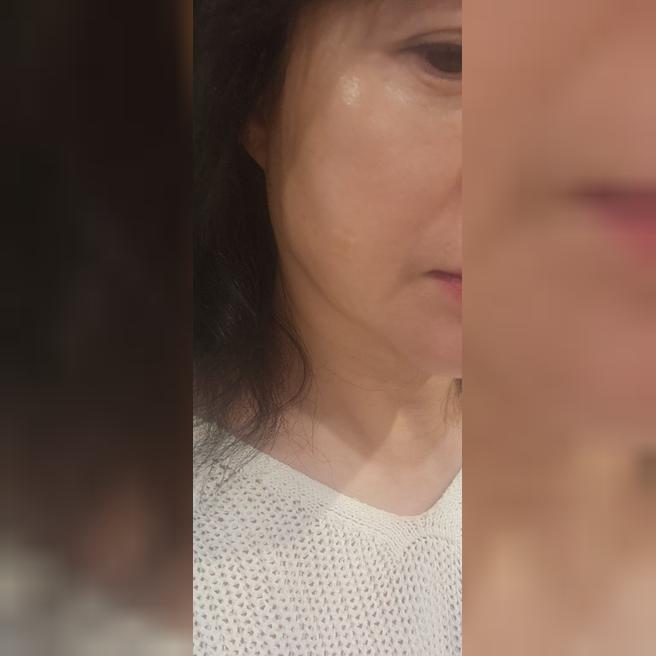 고우리 스킨부스터 맞고 2주, 화장 안 해도 될 것 같은 느낌적인 느낌