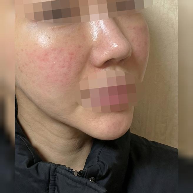 다운타임 짧고, 시술도 만족스러워요~ㅎㅎ