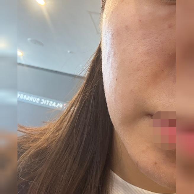 팔자주름 고민으로 리쥬써마, 믿고 또 찾아왔어요ㅎㅎ