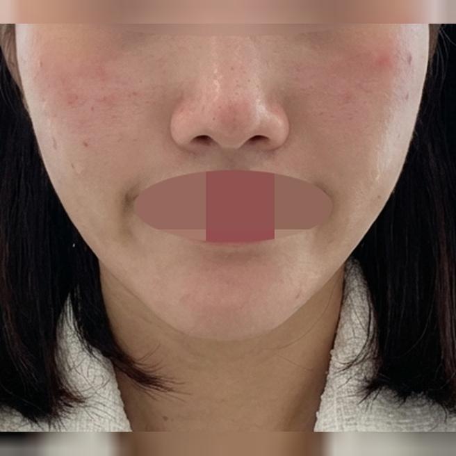 모공과 피부결 개선 하고자 스킨보톡스 받아봤습니다ㅎㅎ