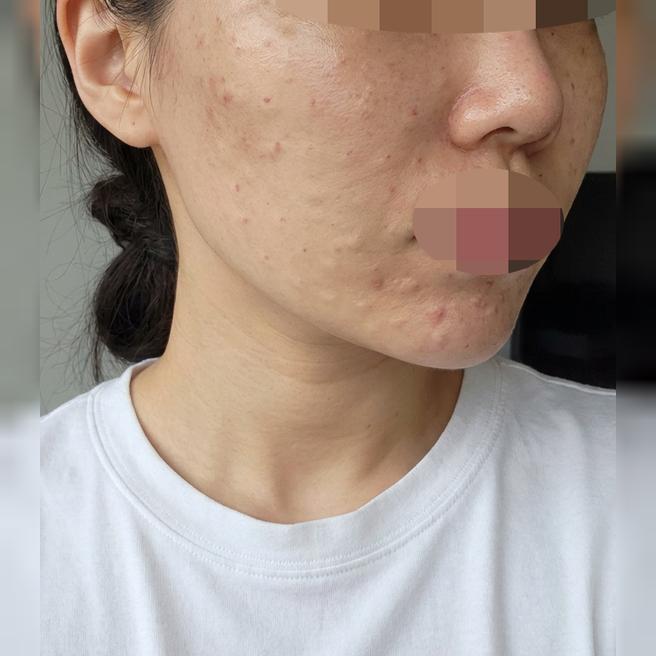 건조함이랑 예민함 고민이라면 리쥬란 진짜 추천드려요><