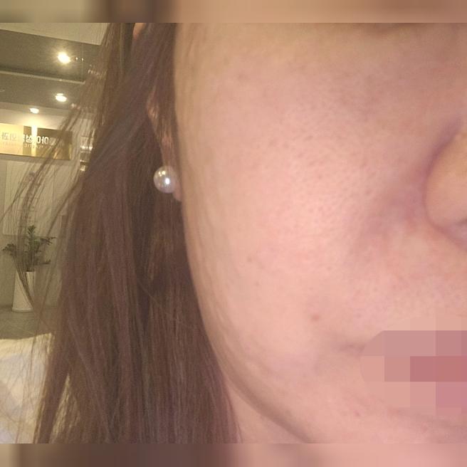 모공이랑 탄력 때문에 고민하다 리쥬란 드디어 도전했어요!