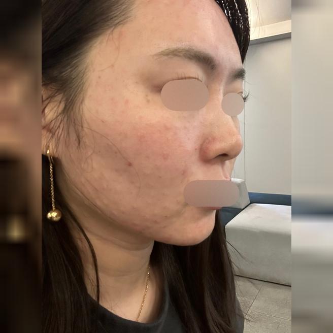 효과 좋아서 다른 곳에서 받다가 여기로 재방문했어요~