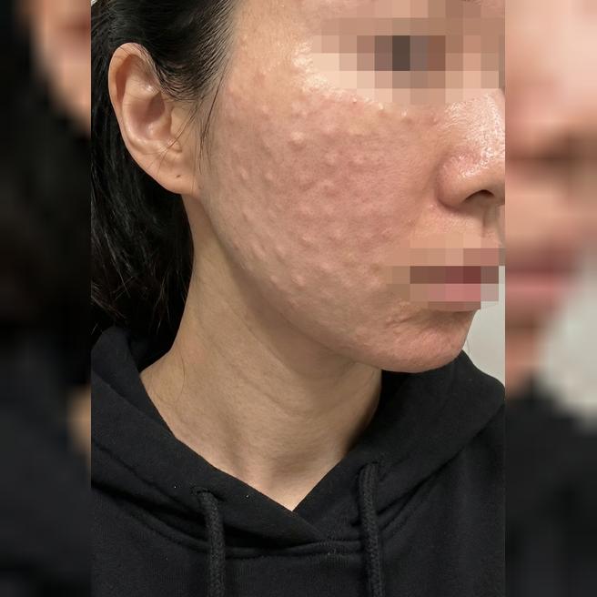 리쥬란 두 번째인데 멍 없이 잘 해주셨어요!