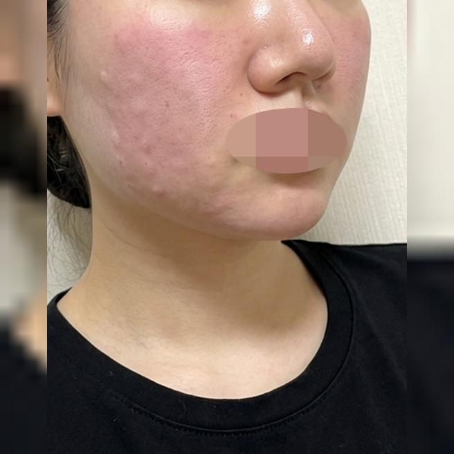 지인 피부 보고 바로 따라한 포텐자, 수면 김에 리쥬란까지 같이 받았어요~