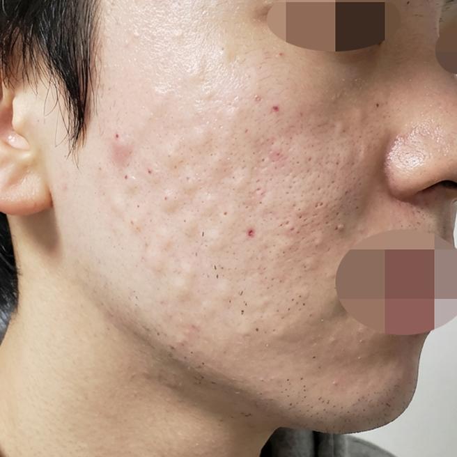 피부 장벽 강화하고자 리쥬란 선택했고 속건조부터 달라졌습니다!