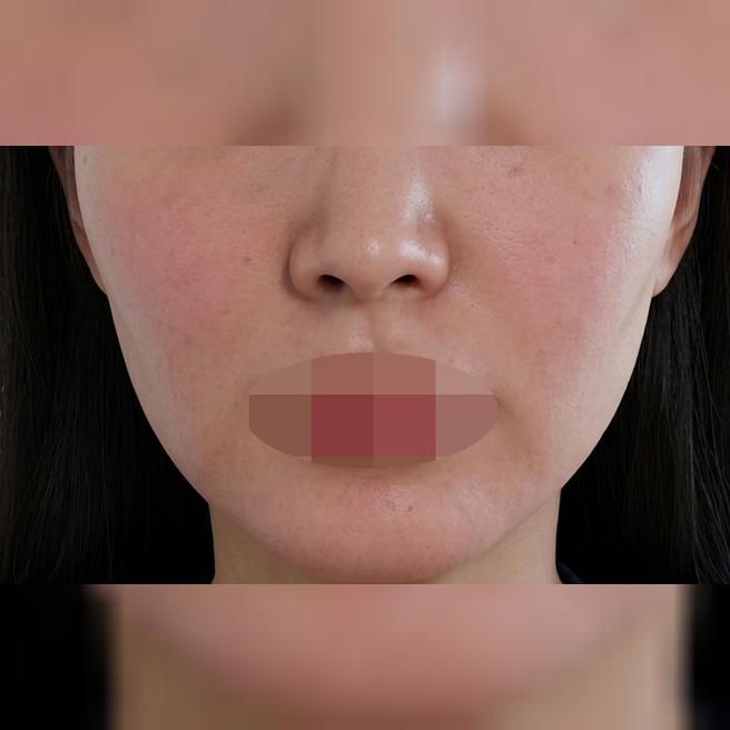 3일 차부터 피부 결이 달라지는 리쥬란, 진짜 추천드려요~!!