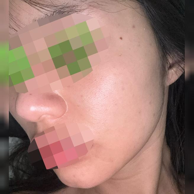 얼굴 칙칙해서 리쥬란힐러 받았는데 괜찮은 것 같아요 ㅎㅎ