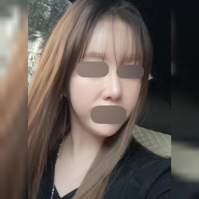 리쥬란 일주일 다 돼가는데 이제 슬슬 효과가 보이는 것 같아요 