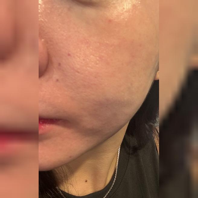 눈밑 잔주름이랑 모공, 홍조 고민으로 아이리쥬란 처음 받아봤어요