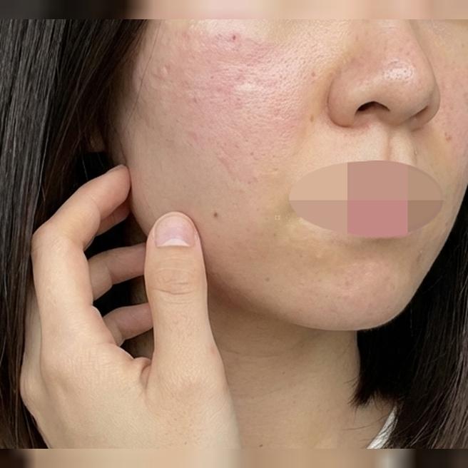 속광 채우고 화장 들뜸 잡으려고 리쥬란 받아봤어요!!