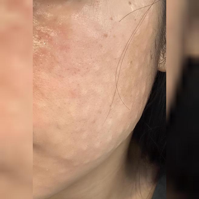 엠보 촘촘하게 올라온 거 보니 효과 기대돼요~!