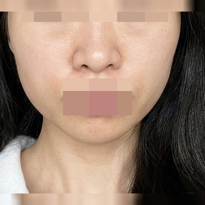 붓기 5일 차부터 빠지기 시작, 10일이면 깔끔하게 정리돼요!