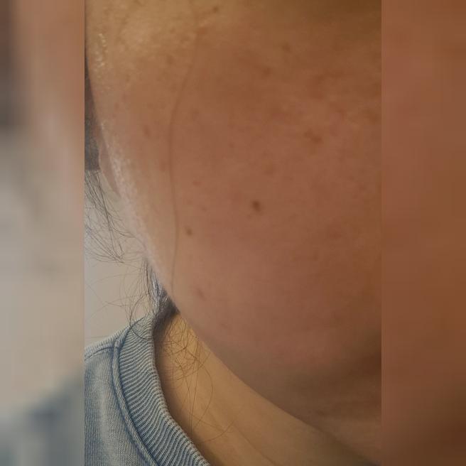 모공 때문에 찾아봤는데 포텐자가 제일 좋다길래 바로 예약했어요