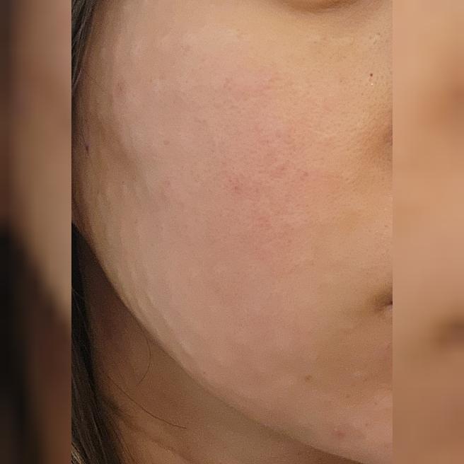 홍조+모공+속건조 고민에 리쥬란힐러 1일차 후기