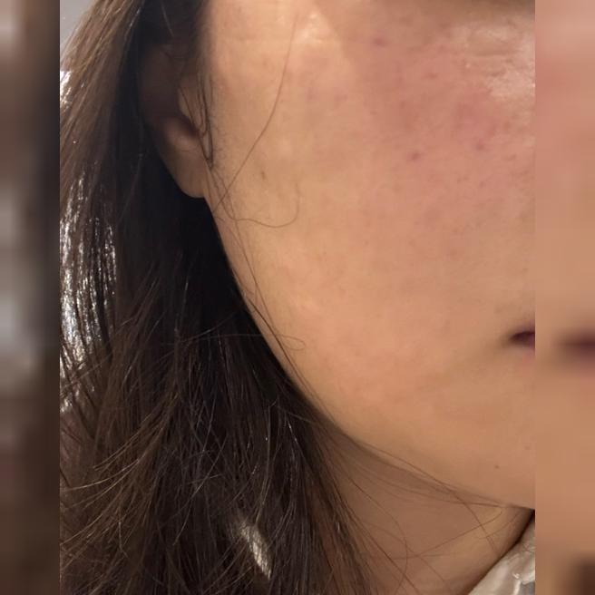 리쥬란 받아봤는데 친절하고 잘 해주셔서 경과가 기대돼요