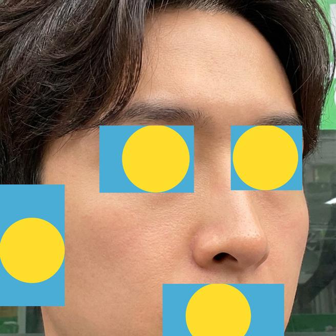 남자도 쥬브아셀 맞아요~~ 시술 3일차 솔직 후기