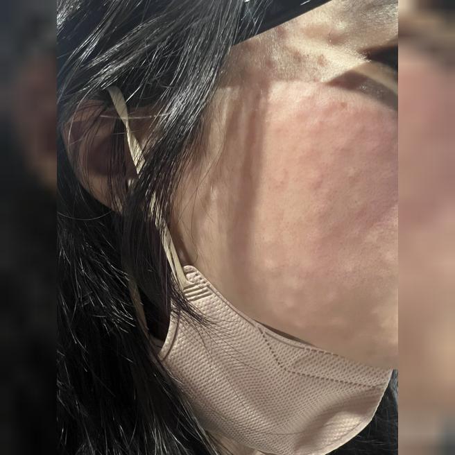 팔자이랑 불독살, 눈가 잔주름 고민으로 울쎄라+리쥬란 받아봤어요!