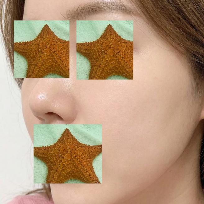 한 달 전 맞은 리쥬란, 지금 피부 상태 공유해요~!