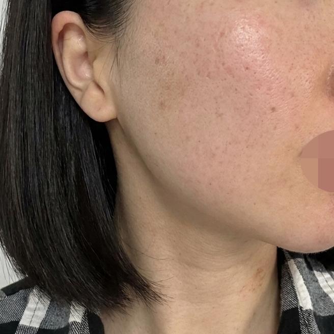 좁쌀 여드름이랑 속건조 고민, 리쥬란으로 해결하러 왔어요~