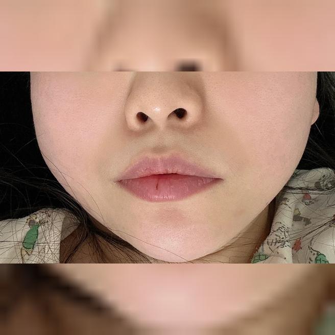 인모드 수면으로 받으니까 눈뜨면 끝! 당일인데 멍도 없어요