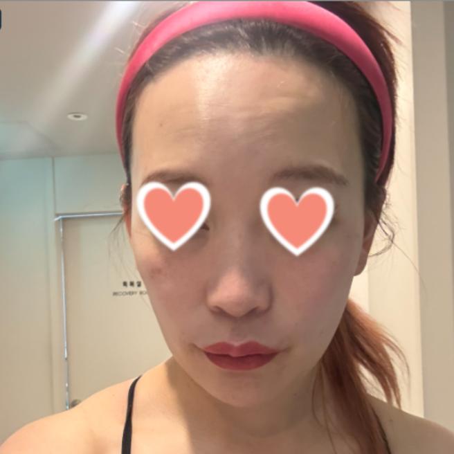 리쥬란 다음날 후기 솔직하게!