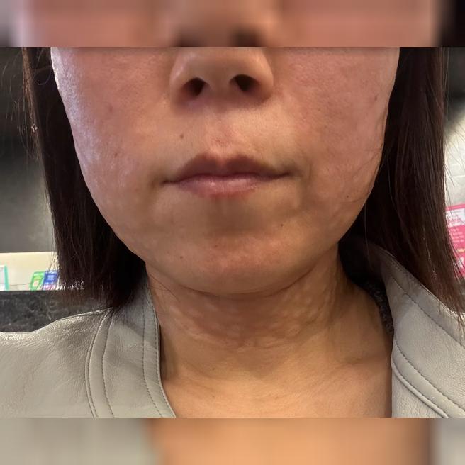 수면 리쥬란 받았는데 아프지 않고 친절해서 물광 피부 기대돼요 ㅎㅎ