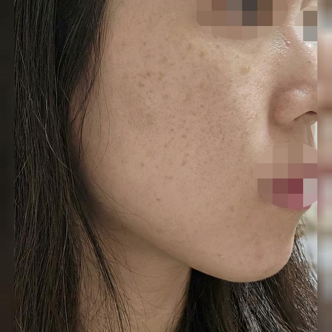 써마지 600샷 처음인데 바로 팔자주름 옅어져서 신기해요 ㅎㅎ